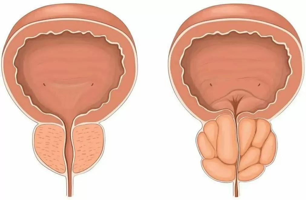 prostata normale e prostata malata
