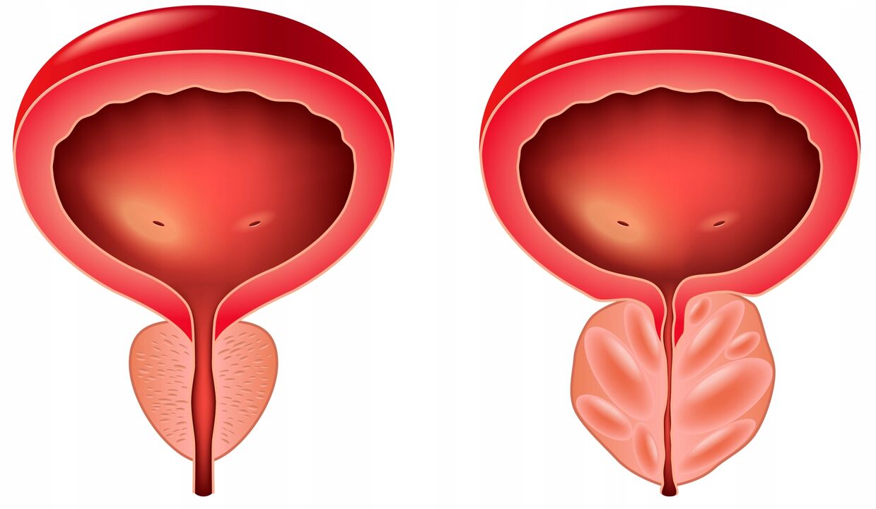 differenza tra le ghiandole della prostata